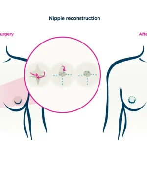 Areola & Nipple Restoration