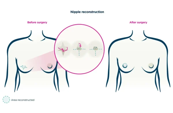 Areola & Nipple Restoration