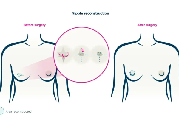 Areola & Nipple Restoration