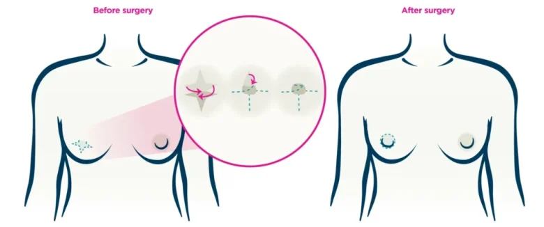 Areola & Nipple Restoration