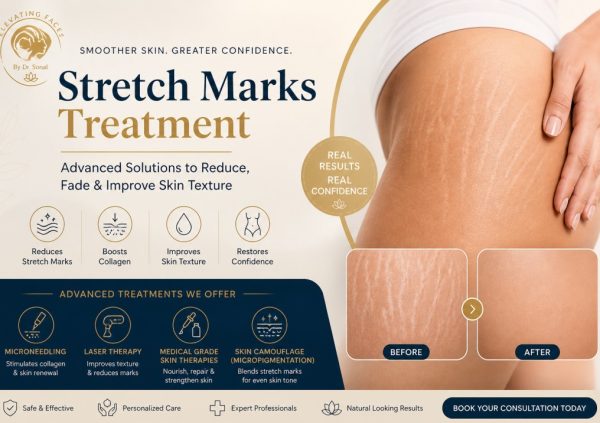 Strech Marks Treatment